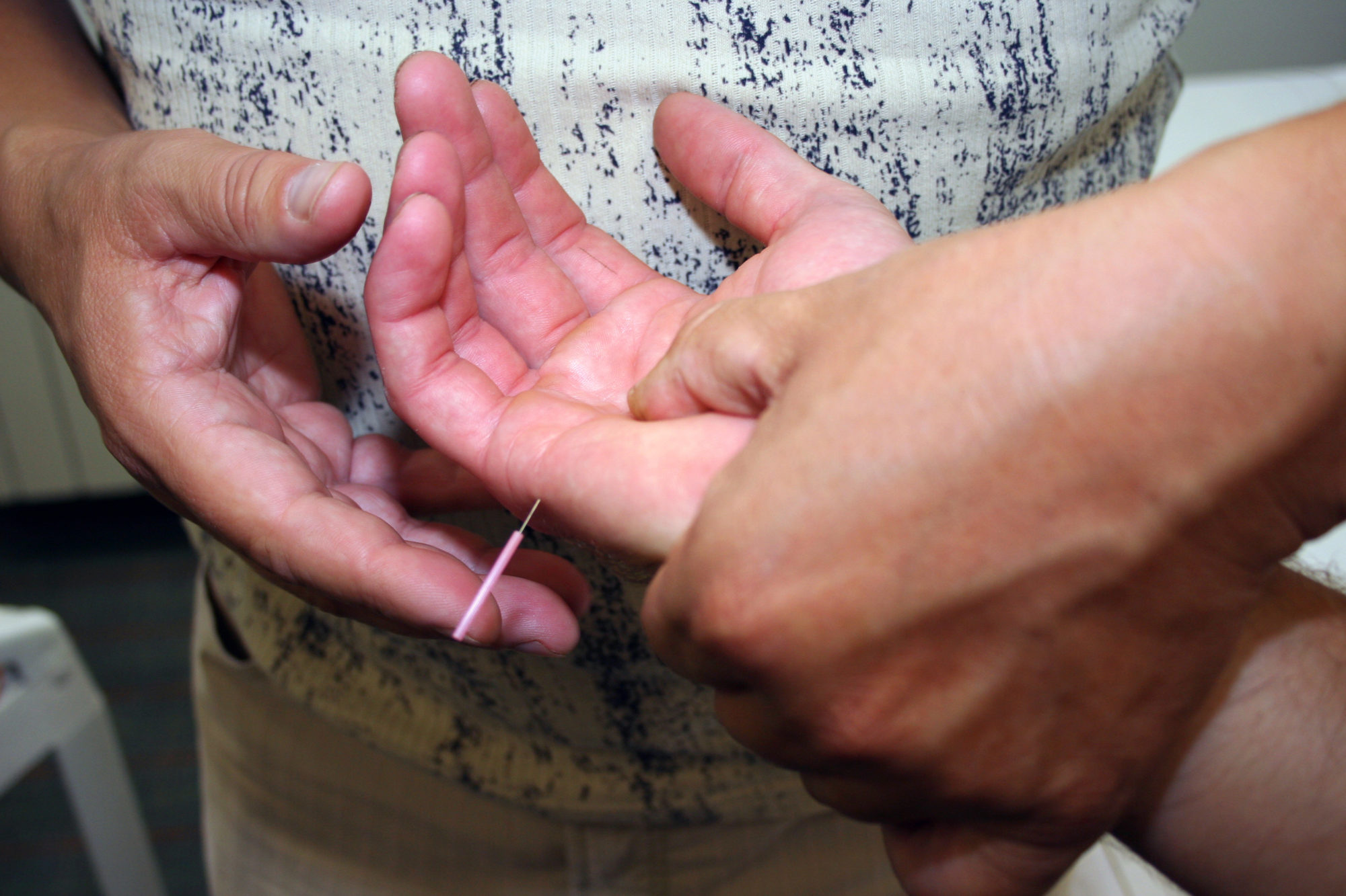 acupuncture treatment in the hand