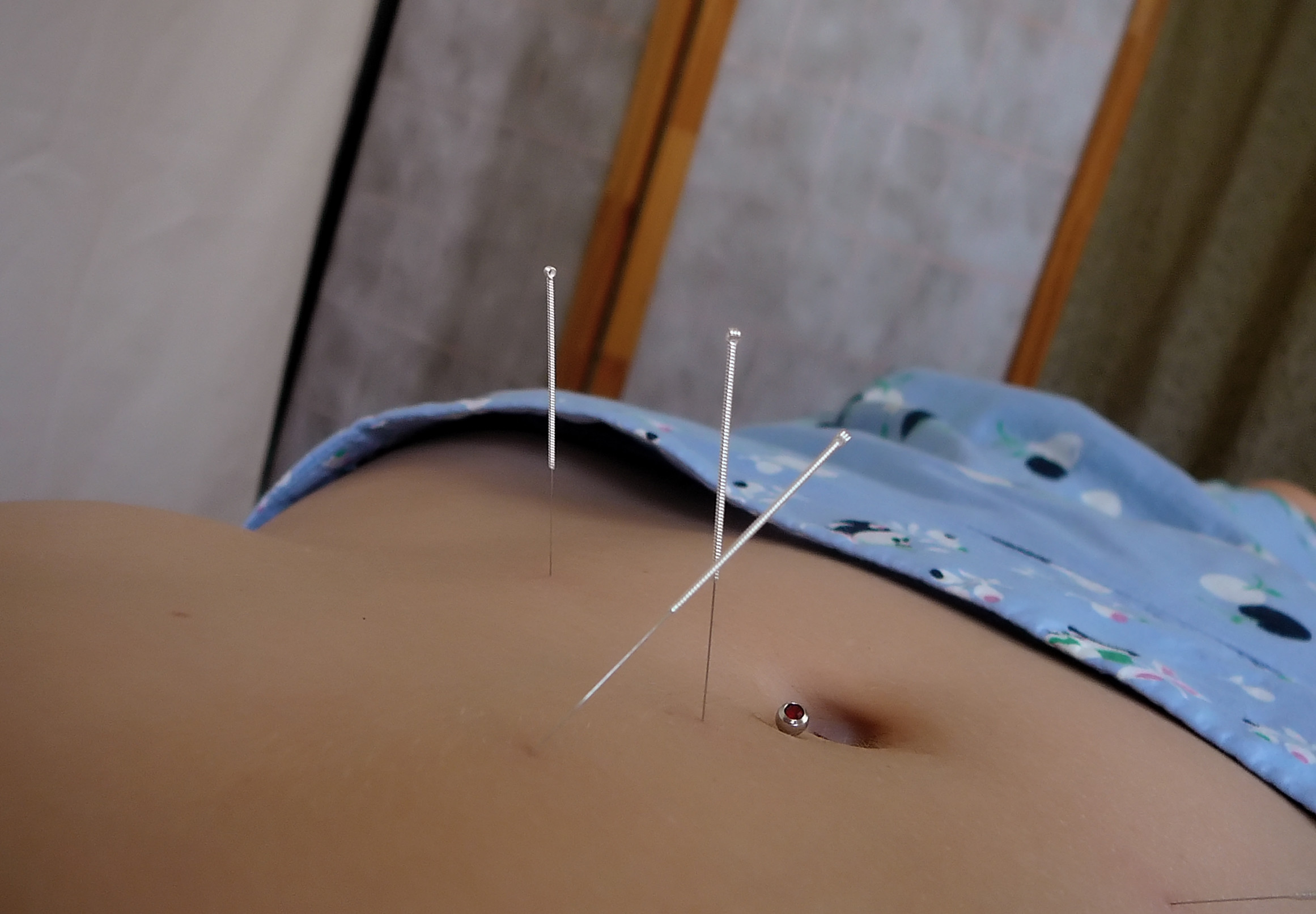 fertility acupuncture for women - increases the chances of getting pregnant when undergoing fertility treatment