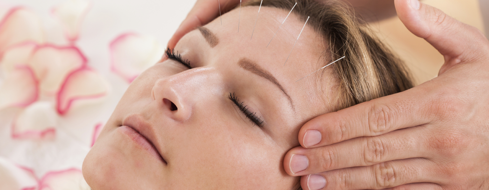 facial acupuncture